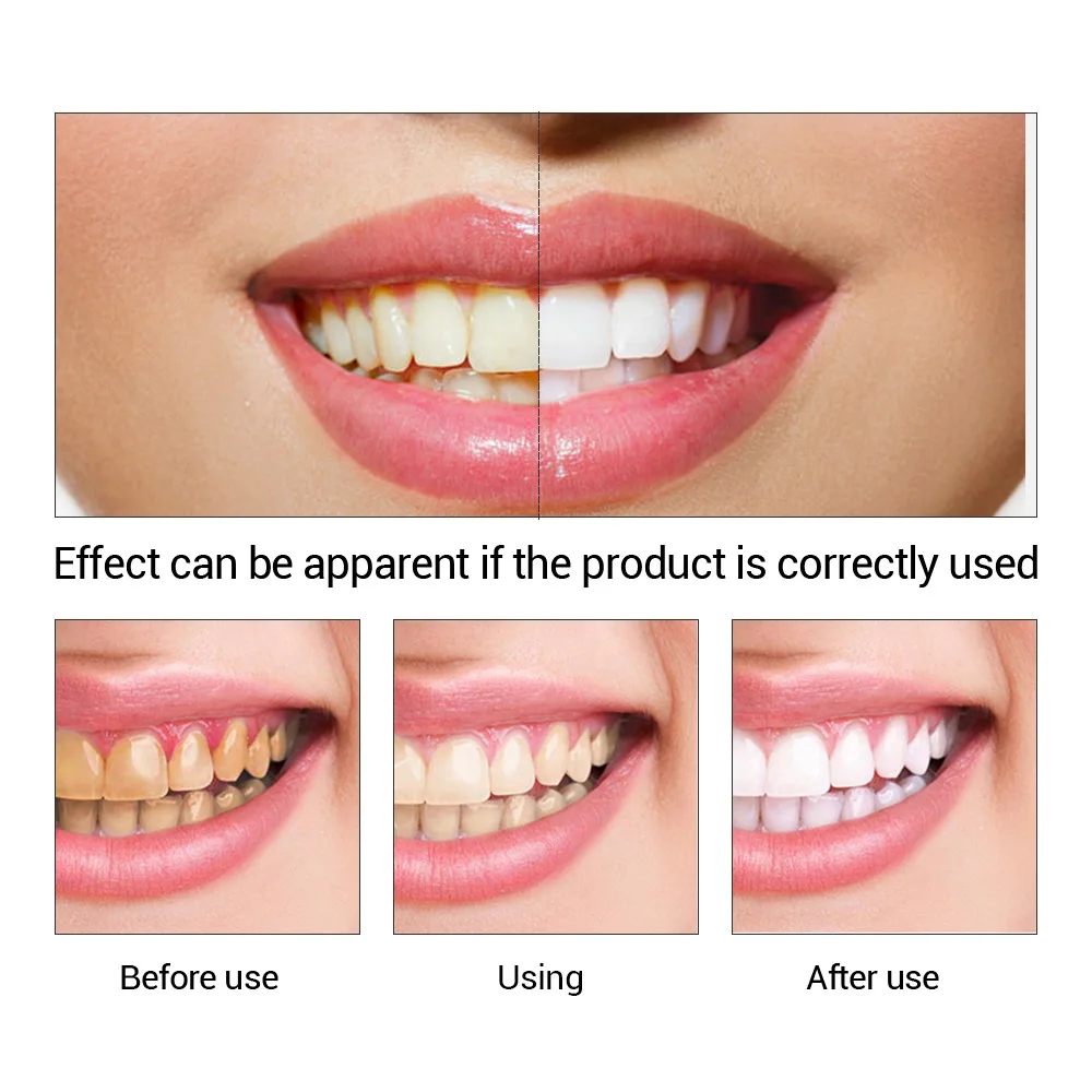 FTEENPLY 치아 미백 에센스 파우더 구강 위생 청 - Teeth Whitening Quotes 리뷰 및 가격